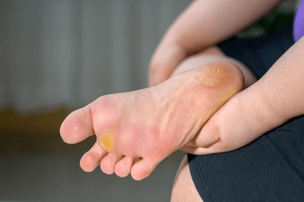 calluses removal in orlando and kissimmee, fl